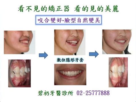 牙齒內傾面相|碧礽牙醫診所